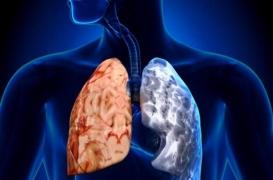 Bronchite chronique de l'adulte : les maladies de l'enfance sont les principales responsables 