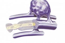 Cancer du cerveau : un vieux médicament offre une nouvelle alternative dans le schwannome