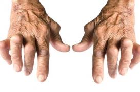 On peut prédire l'efficacité des traitements contre la polyarthrite rhumatoïde