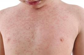 Rougeole: 50% de décès en plus dans le monde entre 2016 et 2019