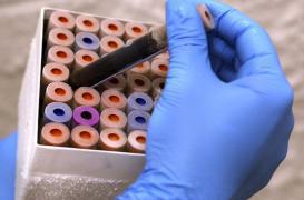 Cancers de la tête et du cou : bientôt détectés dans la salive et le sang