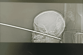 Un petit garçon survit miraculeusement après s’être empalé le crâne sur une broche à viande