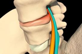 Hernie discale et sciatique : les avantages de la chirurgie seraient très limités