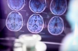 Maladie d’Alzheimer : la piste d’un traitement basé sur les cellules immunitaires se confirme 