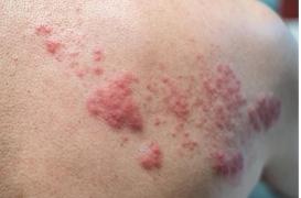 Qu’est-ce que le zona, la maladie de peau dont souffre Benoît XVI ? 