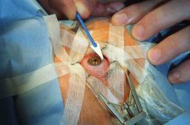 Espagne : 13 patients perdent la vue à cause d'un produit allemand