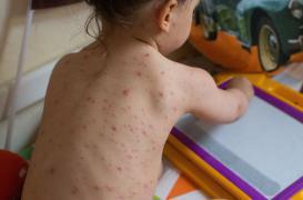  Varicelle : l'épidémie reste forte dans douze régions