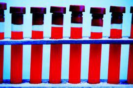 Sida : les vertus insoupçonnées d'un médicament contre l'alcoolisme 