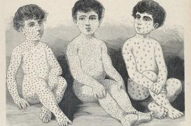 Epidémie de varicelle : comment s’en protéger