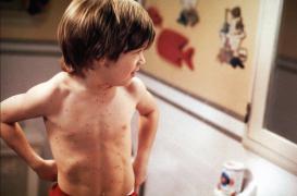 Rougeole : un risque d’épidémie en Alsace