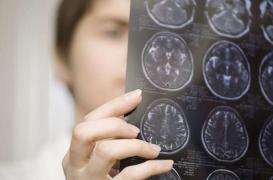 Alzheimer : les premiers signes 18 ans avant le diagnostic
