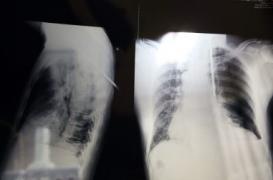 Ile de La Réunion : plus de 300 médecins se mobilisent contre l'ouverture d'une carrière