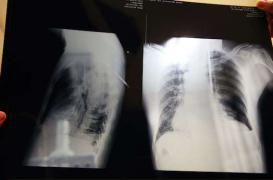 Mucoviscidose : la thérapie génique permet de stopper sa progression