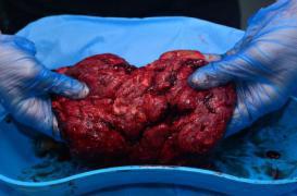 Manger le placenta : une mode qui présente des risques 