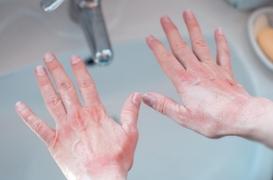 Gestes barrière et gel hydroalcoolique : une flambée de l’eczéma des mains !