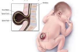 Le spina bifida, une malformation du foetus qui laisse le bas de sa colonne vertébrale à nu