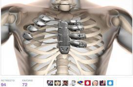 Un sternum imprimé en 3D sauve un patient espagnol