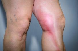 Un anticoagulant oral allège la prévention des thromboses veineuses associées au cancer