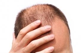 La calvitie est dangereuse pour le cœur