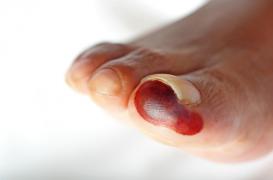 Diabète : 9 000 personnes amputées par an en France