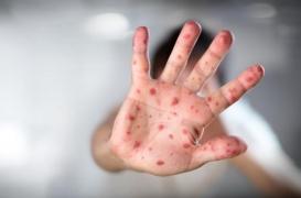 115 cas de rougeole en Nouvelle-Aquitaine. Combien ailleurs ?
