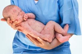 Rougeole : les cas ont augmenté de 400% partout en Europe