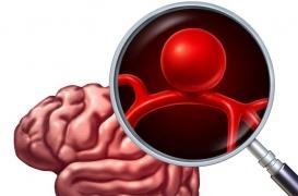Ruptures d’anévrismes : la découverte de la mutation d'un gène rend possible la prévention