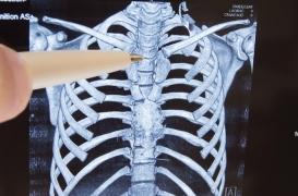 Un anticorps contre les métastases osseuses divise leur fréquence par 100