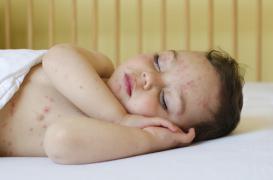 Varicelle : les Pays-de-Loire particulièrement touchés 