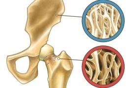 Quand faut-il craindre une ostéoporose ?