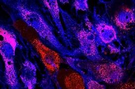 Une modeste anomalie du sang peut conduire insidieusement à un cancer 30 ans après 