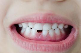 Dentition des enfants : attention aux sports de contact