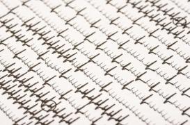 La fibrillation auriculaire sans symptôme relève le défi de sa prise en charge