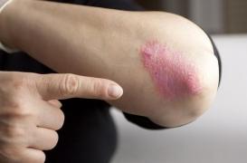 Le psoriasis doit sortir de l’ombre
