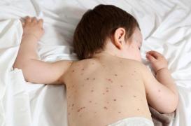 Varicelle : plusieurs régions dans le rouge