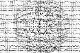 Les traitements modernes contre l’épilepsie ne seraient pas plus efficaces que les anciens