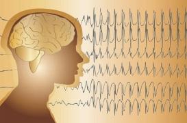 10 questions sur l’épilepsie