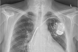 Il est possible de passer une IRM avec un pace-maker 