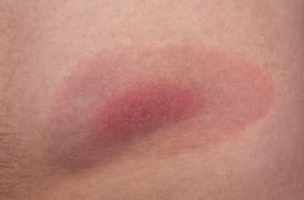 Maladie de Lyme : 300 malades portent plainte contre l’état et contre la science