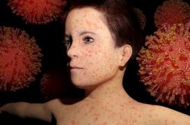 Rougeole : 77 cas à Bordeaux et une épidémie qui s'étend