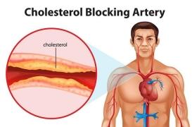 Cholestérol LDL, le principal annonciateur d’athérosclérose 