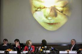 Les visages transplantés vieillissent prématurément