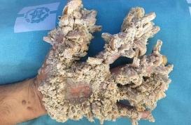 Homme-arbre : un Palestinien opéré à Jérusalem