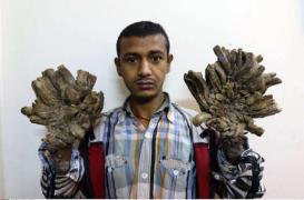 Maladies rares : appel à un nouveau plan national