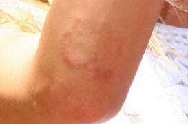 Psoriasis : les jeunes patients souvent isolés