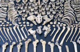 Ostéoporose : plus grave chez les hommes