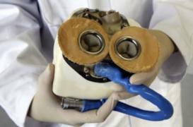 Carmat : le troisième patient implanté est rentré chez lui