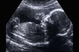 Dépakine : les patientes ignorent encore les risques