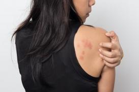 L'éruption d’urticaire provoquée par le froid serait liée à une maladie génétique