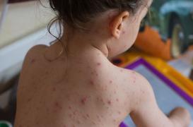 Varicelle : flambée dans onze régions